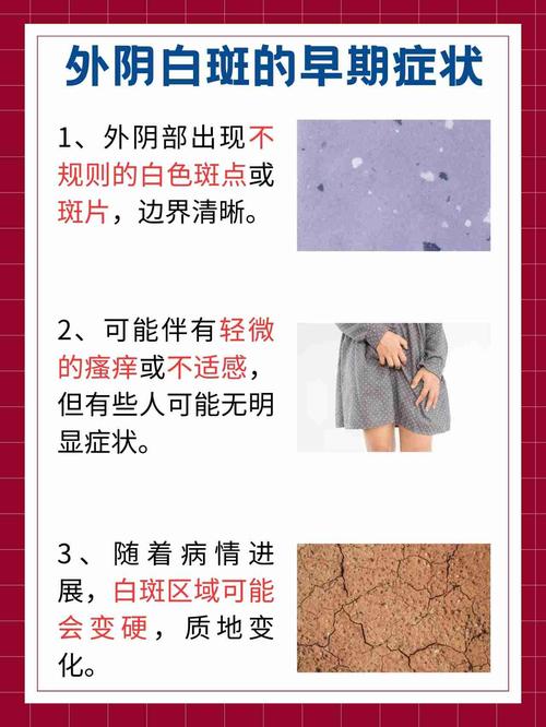 女性妇科白斑症状-妇科白斑是不是真的治不好